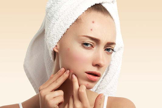 I take care of my skin, but my acne isn't going away. What am I doing wrong?